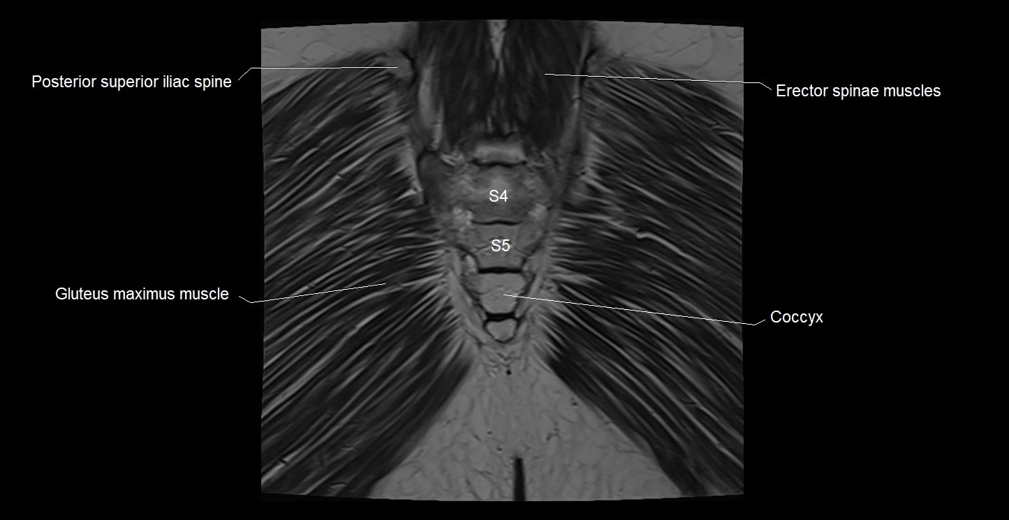 MRI coronal cross sectional anatomy male pelvis image 40.webp